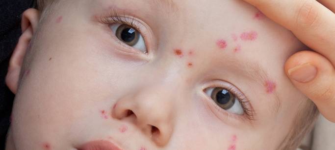 Weniger Windpockenfälle