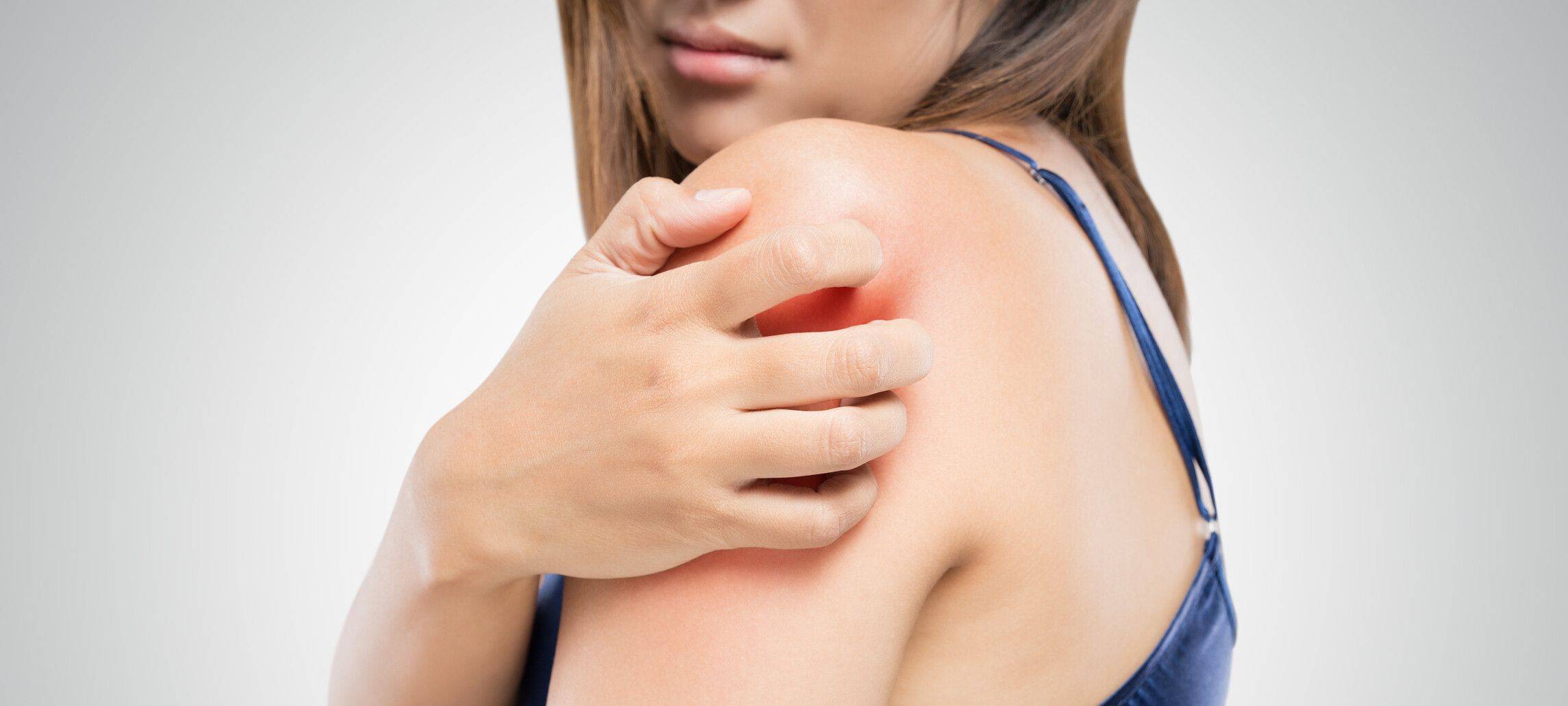 Krätze-Fälle im Ennepe-Ruhr-Kreis gesunken