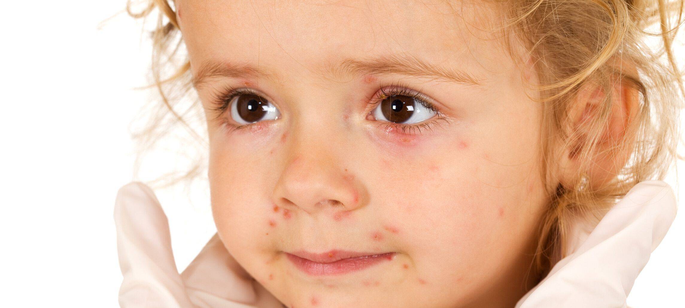 Weniger Windpocken Fälle