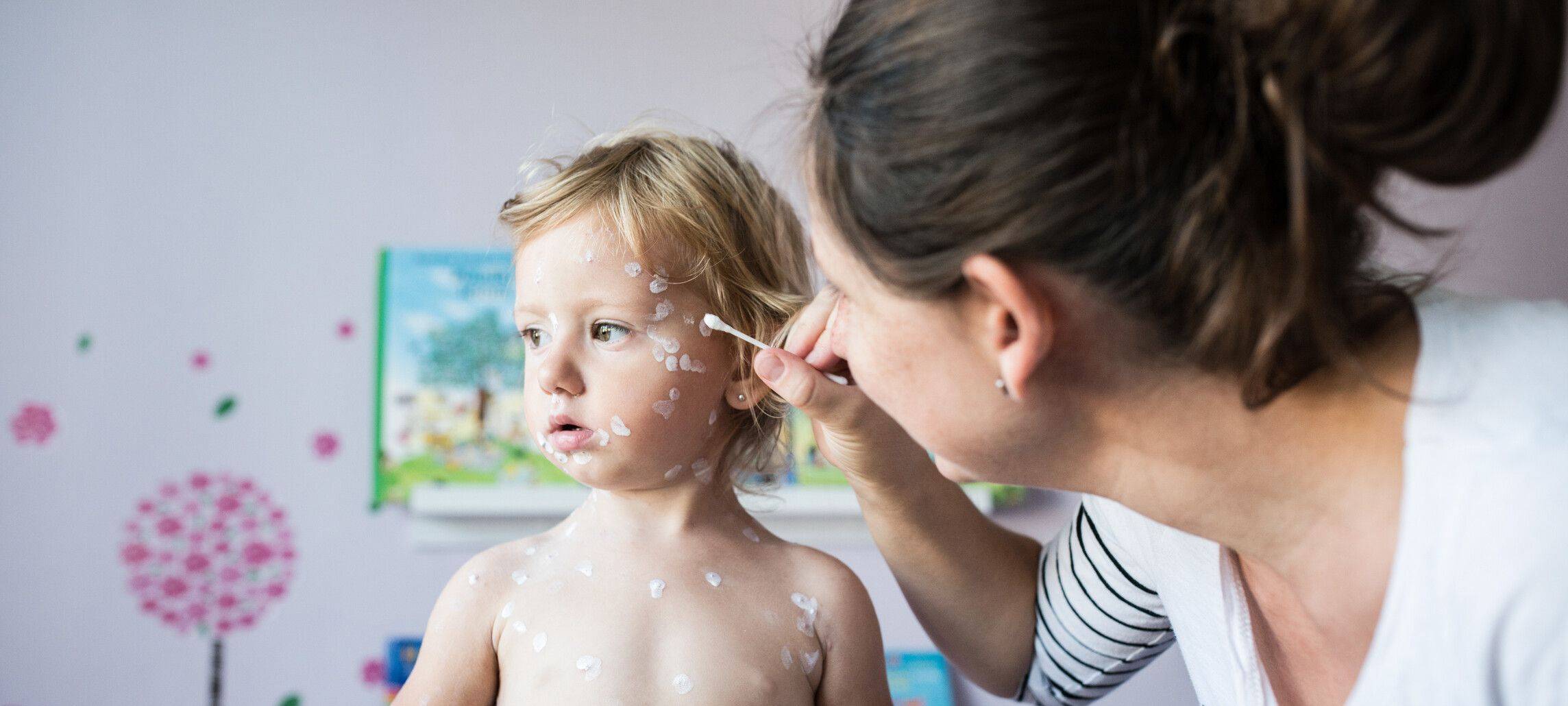 Windpockeninfektionen steigen