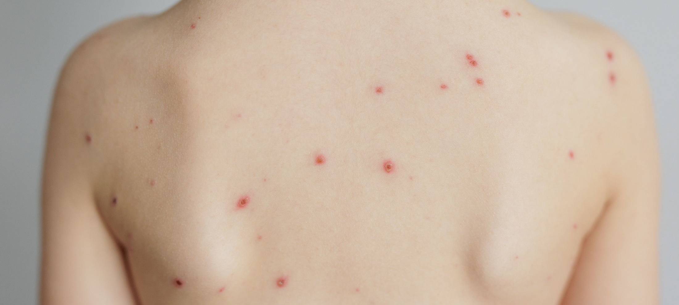 Wieder mehr Windpockenfälle im Kreis