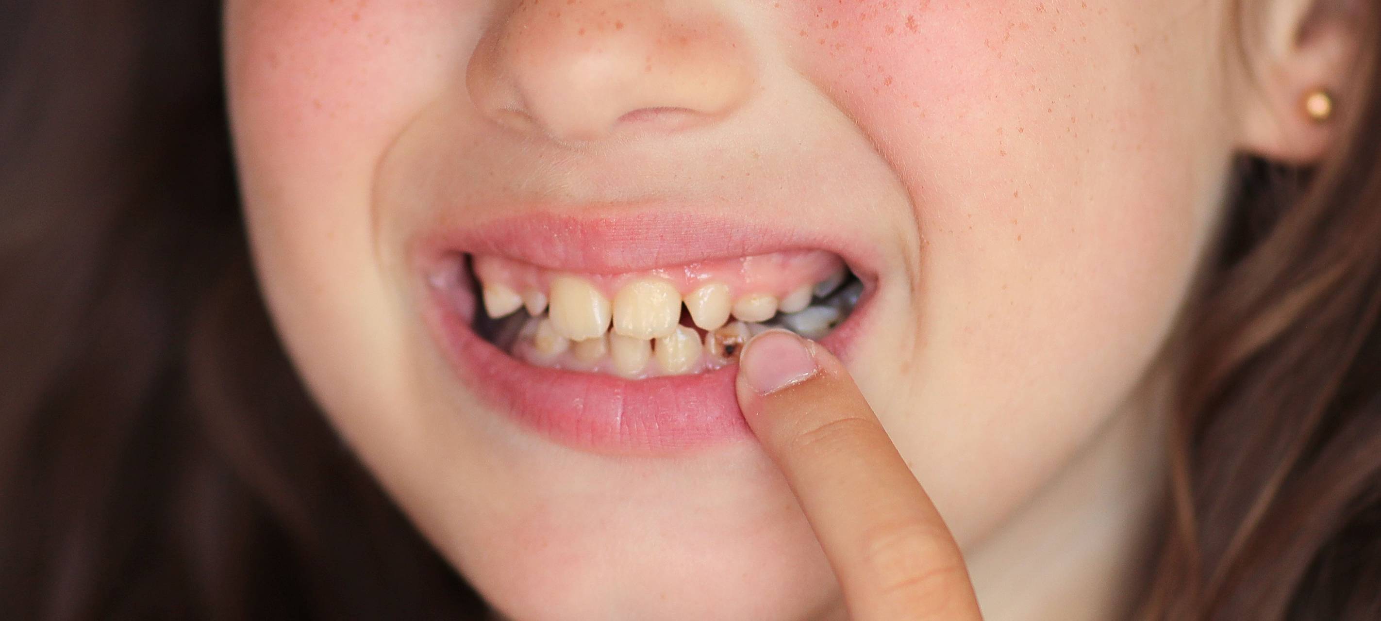 Viele I-Dötzchen schon mit Zahnfüllungen